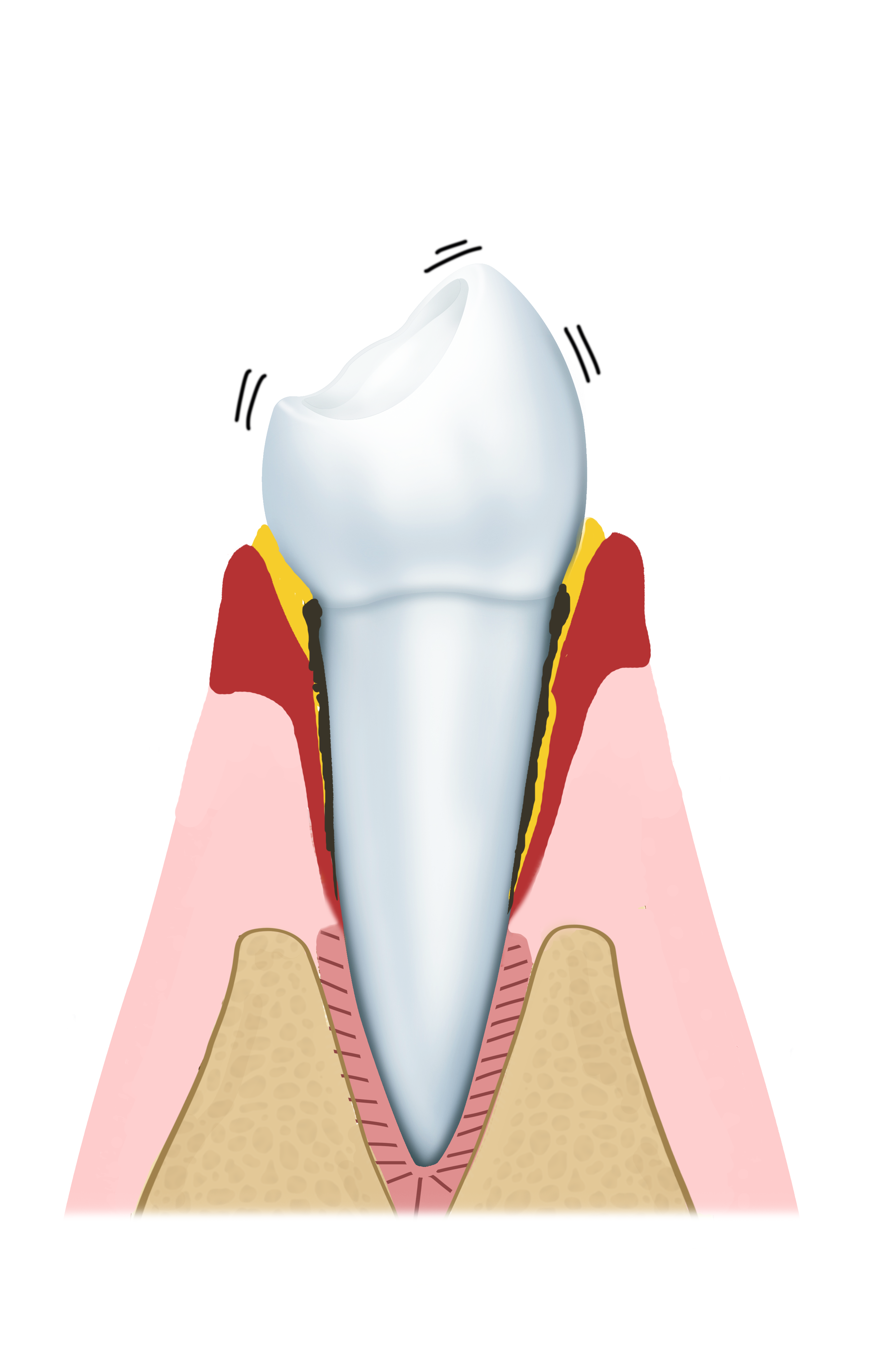 vergevorderde paradontitis